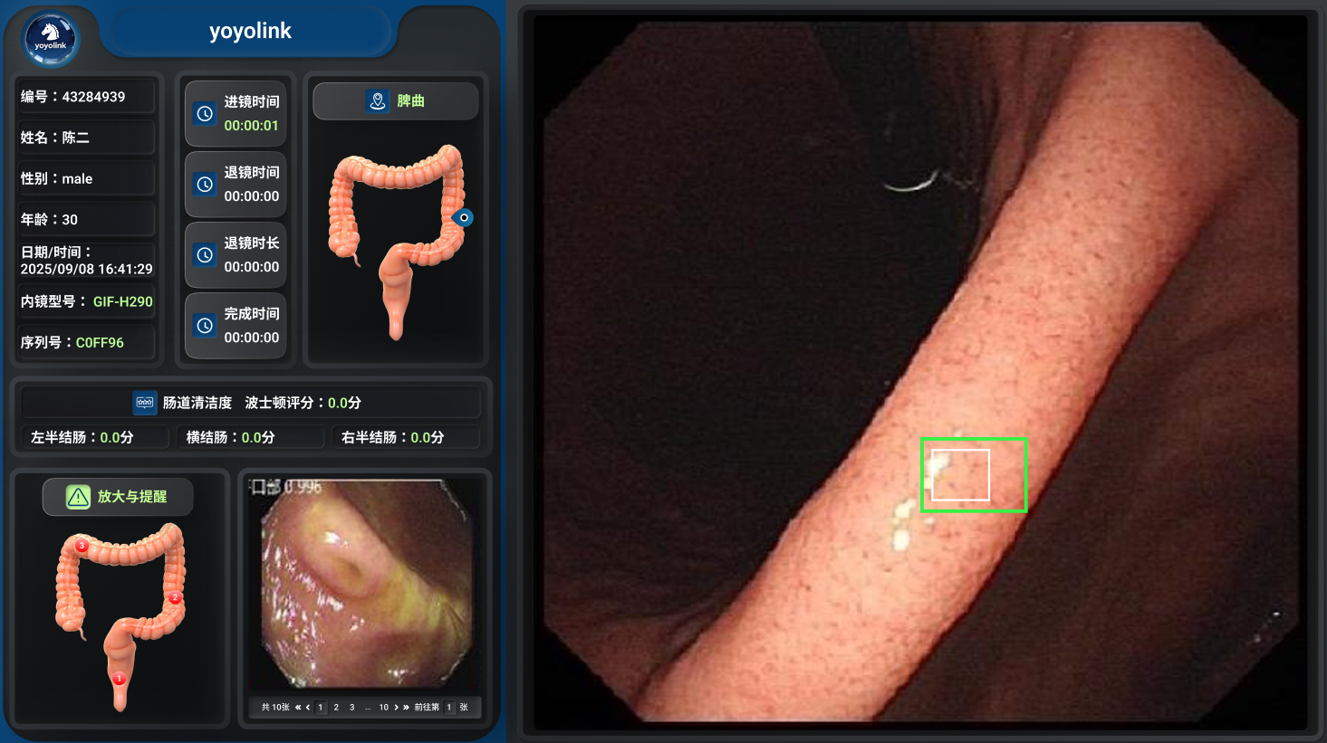 yoyolink AI GI Endoscopy System — AI-assisted colonoscopy interface with real-time site and lesion annotation